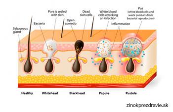 Zinok na akné. Zinok tablety proti akné na pleti, tvári, chrbte, krku. Čo je dobré na akné? Čo na akné v puberte?